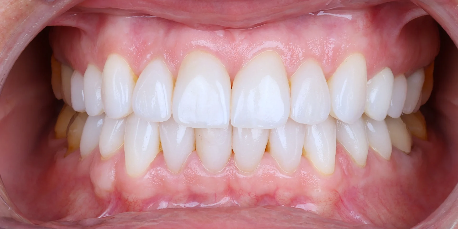 Vue intra-orale de face en occlusion, gros plan réalisé au protocole de photographie dentaire