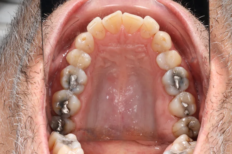 Vue occlusale maxillaire au miroir, photographie intra-orale au protocole