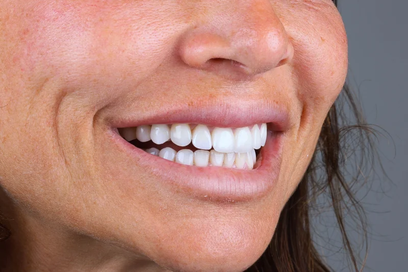 Sourire de trois quarts, vue exobuccale du protocole de photographie dentaire