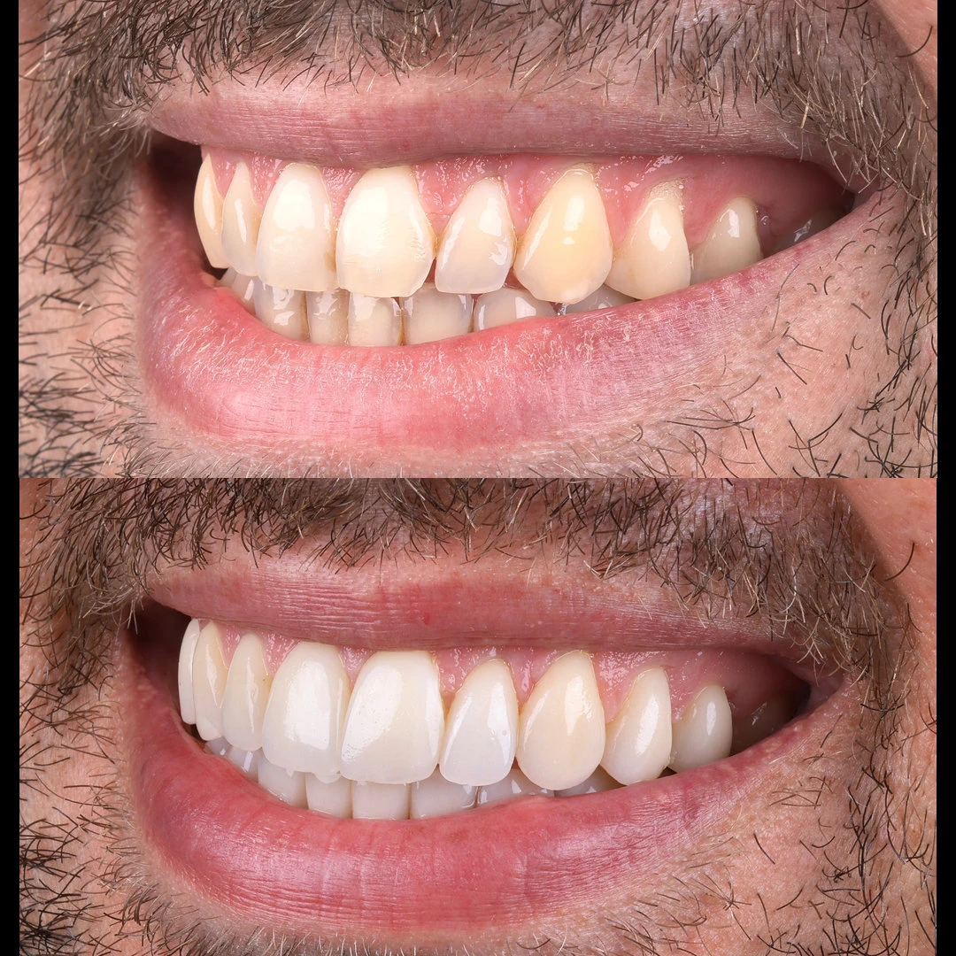 Sourire de trois quarts, avant et après traitement, même axe et même distance de prise de vue