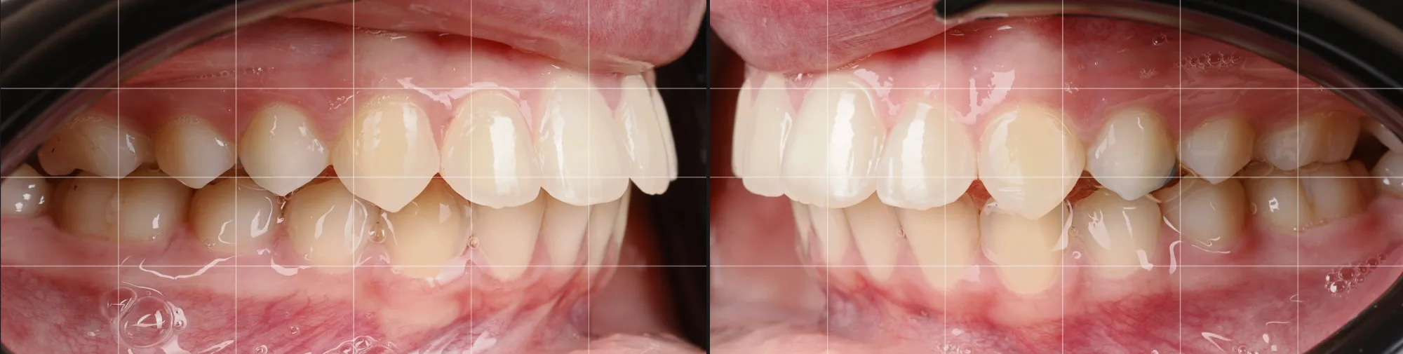 Reproductibilité en photographie dentaire — occlusion latérale avant / après avec grille de composition